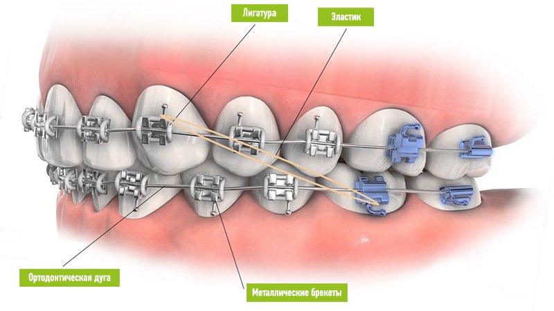 Anatomy_Braces.jpg