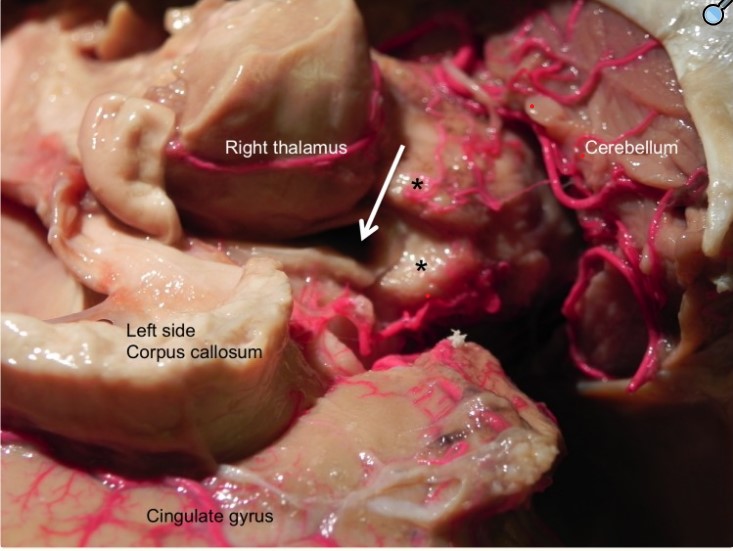 аплазия эпифиза.jpg